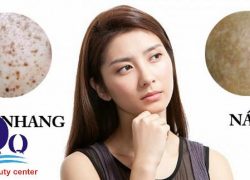 Cách phân biệt giữa tàn nhang và nám